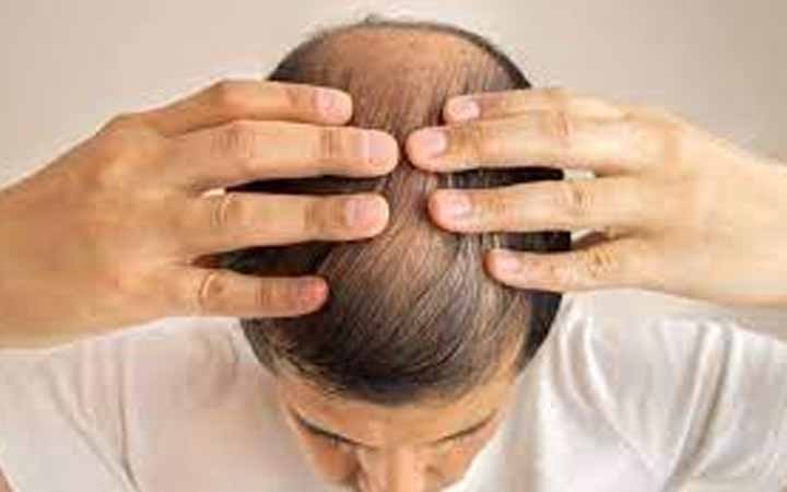 চুল পড়ার সমস্যায় কিছু ঘরোয়া টোটকা