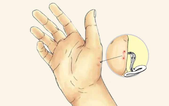 সাপে কাটলে প্রাথমিকভাবে যা করা উচিত