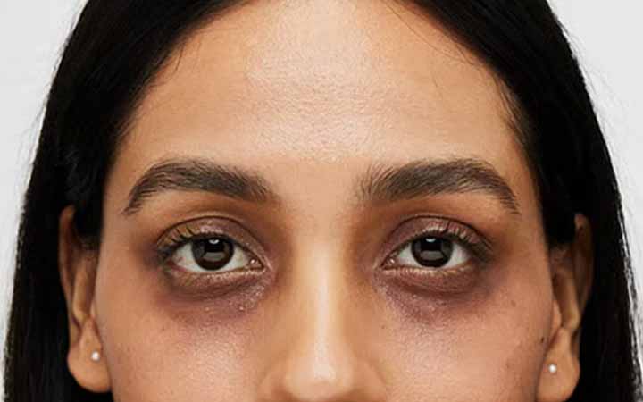 চোখের নিচের কালো দাগ কমানোর ঘরোয়া টোটকা