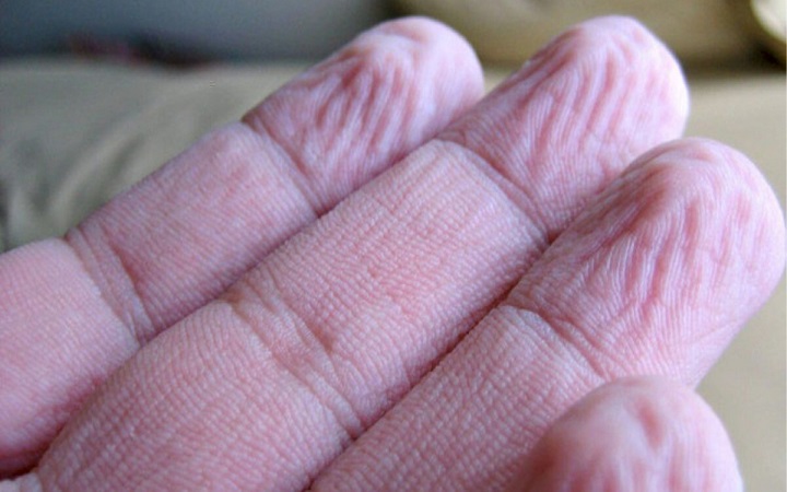 পানি ধরলেই আঙুল কুঁচকে যায়, বড় কোন রোগের লক্ষণ নয় তো?