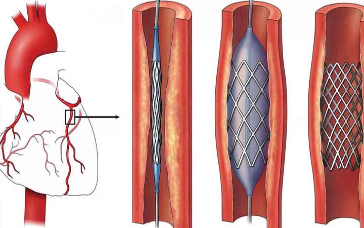 সেপ্টেম্বরের মধ্যে হার্টের রিংয়ের দাম কমাবে ঔষধ প্রশাসন