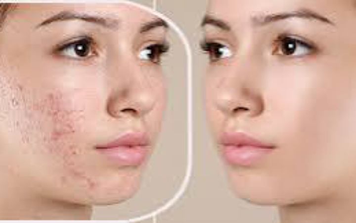 এই শীতে ব্রণ থেকে মুক্তি পাওয়ার উপায়