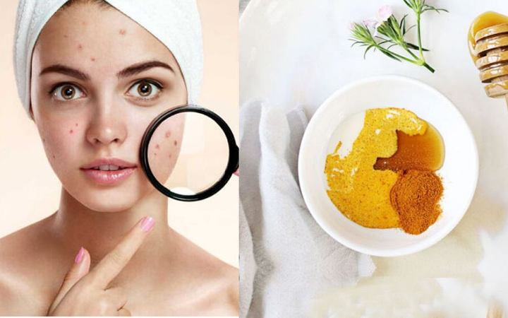 শীতে ত্বকের পোড়া দাগ দূর করতে ব্যবহার করুন তেঁতুল