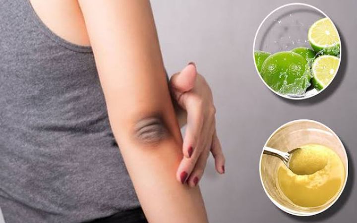 জেনে নিন কনুইয়ের কালো দাগ দূর করার উপায়
