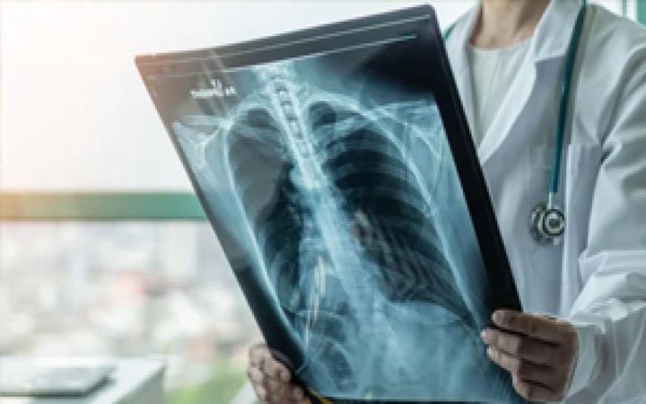 মালয়েশিয়ায় দ্রুত বাড়ছে যক্ষ্মা, বিশেষ সতর্কতা জারি