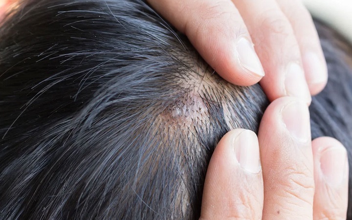 মাথার ত্বকে ব্রণ হলে কী করবেন?