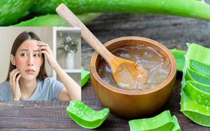 সানবার্ন দূর করতে অ্যালোভেরা ব্যবহার করবেন যেভাবে