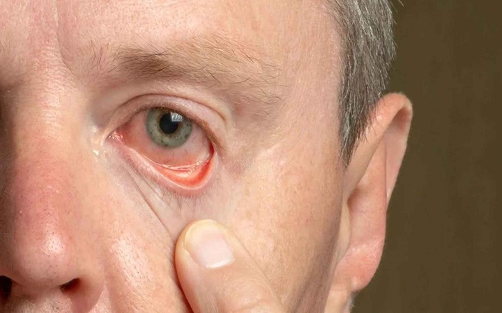 ত্বকের ৫ লক্ষণ দেখা দিলেই বুঝবেন কোলেস্টেরল বেড়েছে