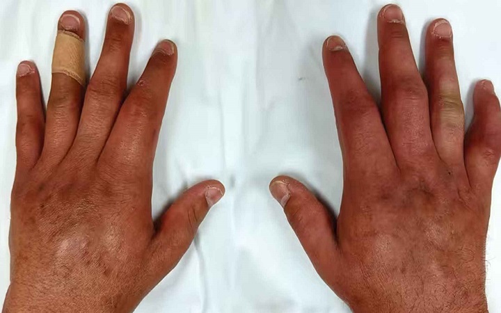 হাতের আঙুল ফুলে গেছে? হতে পারে এসব রোগের ইঙ্গিত