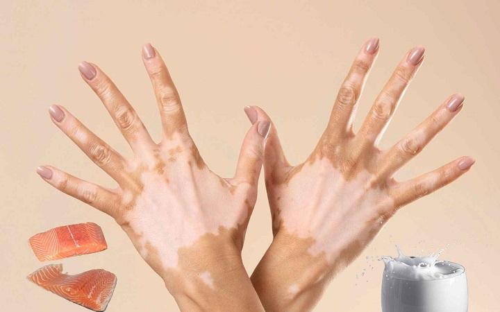 দুধ আর মাছ একসঙ্গে খেলে কি শ্বেতী রোগ হয়?