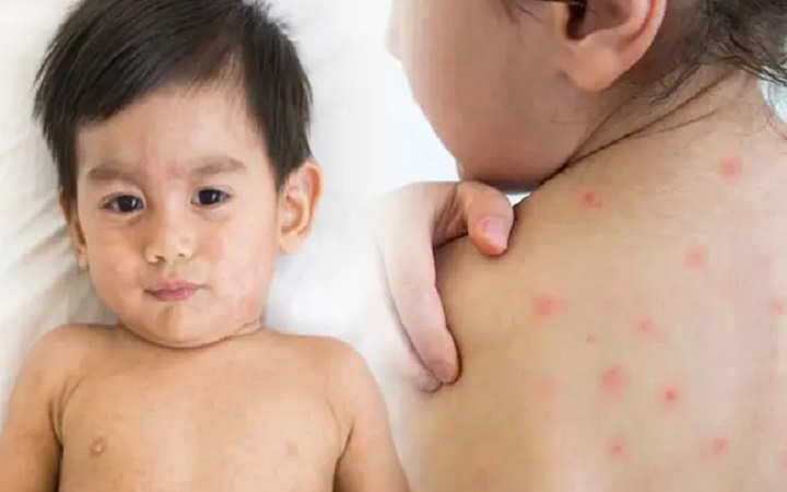 এসব লক্ষণ দেখলেই বুঝবেন আপনার শিশু হামে আক্রান্ত