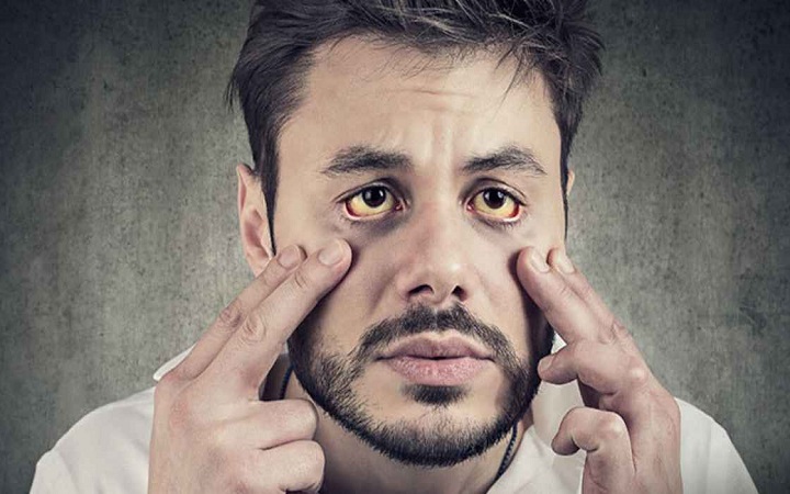 জন্ডিস কি ছোঁয়াচে রোগ?