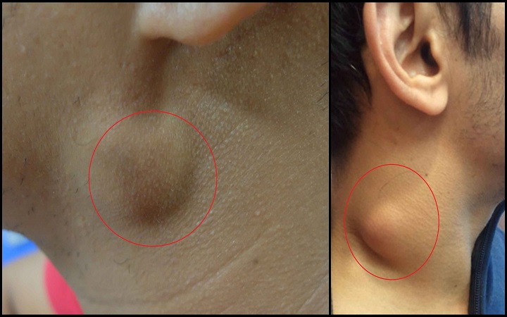 গলার কাছে হঠাৎ ফোলা মাংসপিণ্ড, বিপজ্জনক নয় তো?