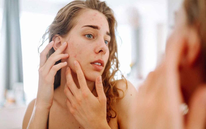 মানসিক চাপের কারণে কি ব্রণ হতে পারে?