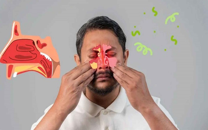 শীতে বাড়ে সাইনাসের ব্যথা, কমানোর ঘরোয়া উপায় জানুন