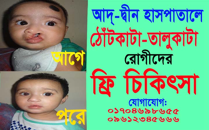 আদ্-দ্বীন হাসপাতালে ঠোঁটকাটা তালুকাটা রোগীদের ফ্রি চিকিৎসা।। নিউজজোনবিডি, আদ্-দ্বীন।।