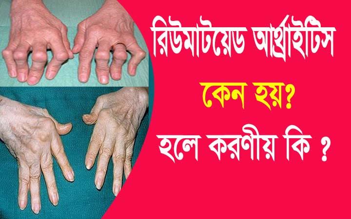 রিউমাটয়েড আথ্রাইটিস কেন হয়? হলে করণীয় কি ?